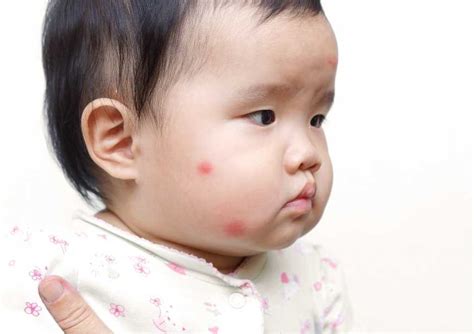 Bebeklerde böcek alerjisi